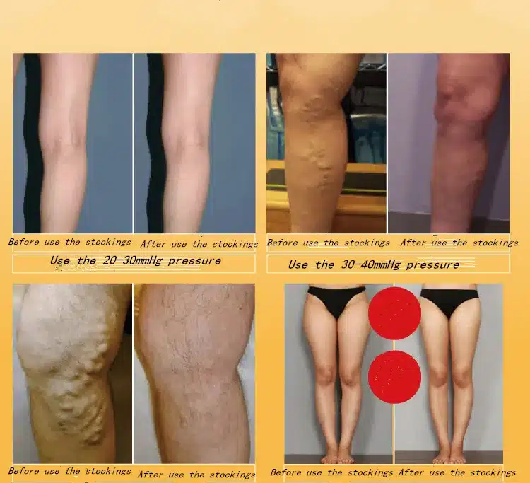 One Pair Medical Compression Stockings Varicose Veins 20-30mmhg Pressure High - Above The Knee Compression Stockings 14