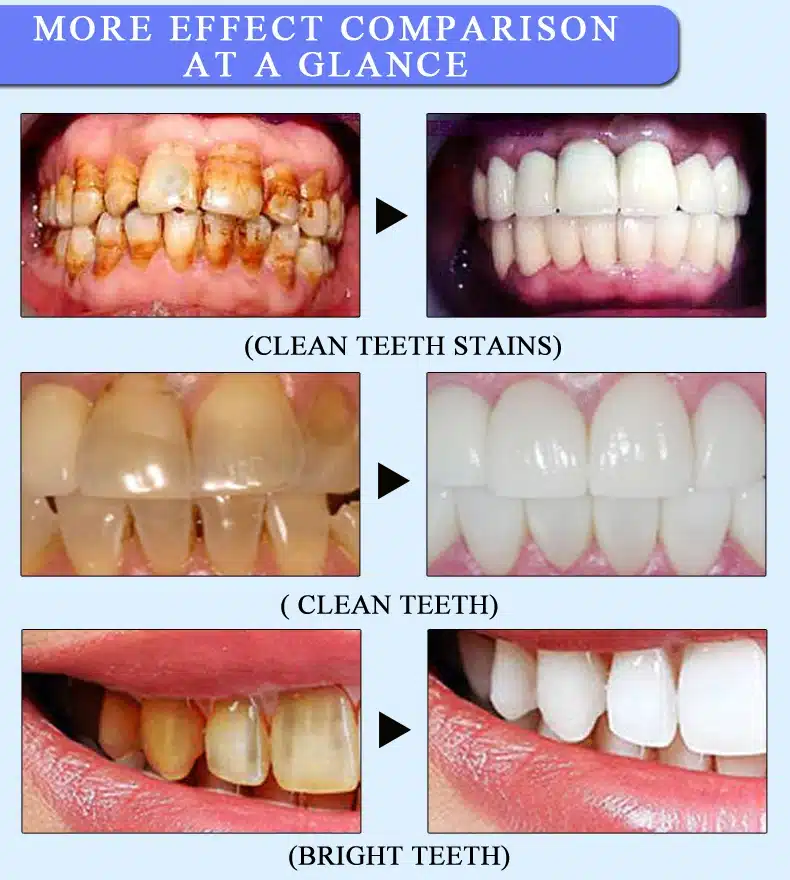 MeiYanQiong Oral CleansingTeeth Whitening Essence Effectively Removes Tartars Teeth Cleaning Oral Hygiene Dental Tools Oral Care 11