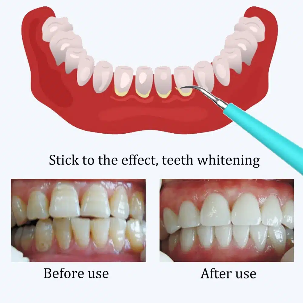 New Oral teeth whitening clean Home Use Teeth Stains Scaling Tool Tooth Stain Remover Tartar Dental Scaler Cleansing Machine 11