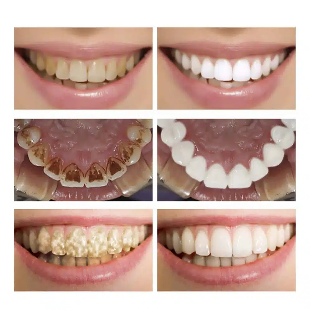 New Oral teeth whitening clean Home Use Teeth Stains Scaling Tool Tooth Stain Remover Tartar Dental Scaler Cleansing Machine 23