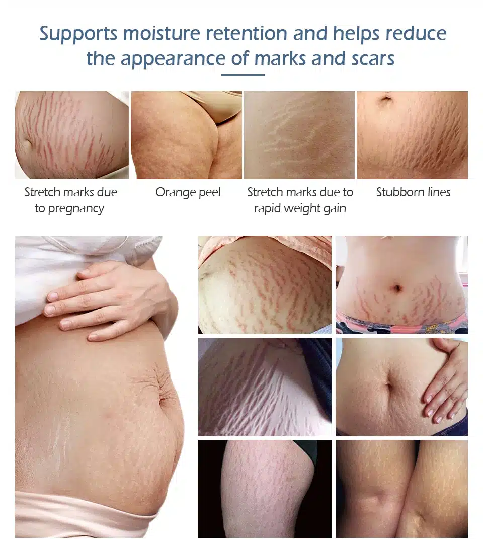VIBRANT GLAMOUR Crocodile Stretch Marks Remover Pregnancy Scars Ance Cream Maternity Repair Anti Aging Winkles Firming Body Care 11
