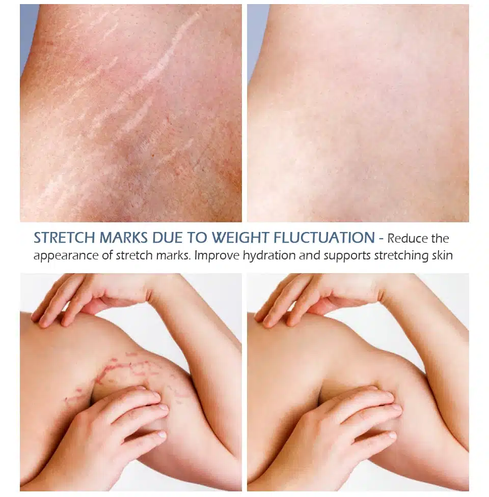 VIBRANT GLAMOUR Crocodile Stretch Marks Remover Pregnancy Scars Ance Cream Maternity Repair Anti Aging Winkles Firming Body Care 14