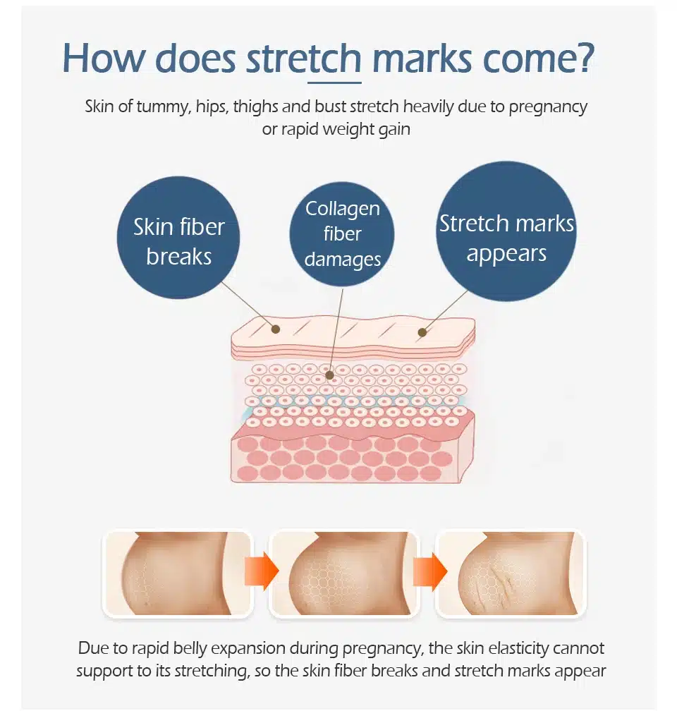 VIBRANT GLAMOUR Crocodile Stretch Marks Remover Pregnancy Scars Ance Cream Maternity Repair Anti Aging Winkles Firming Body Care 18