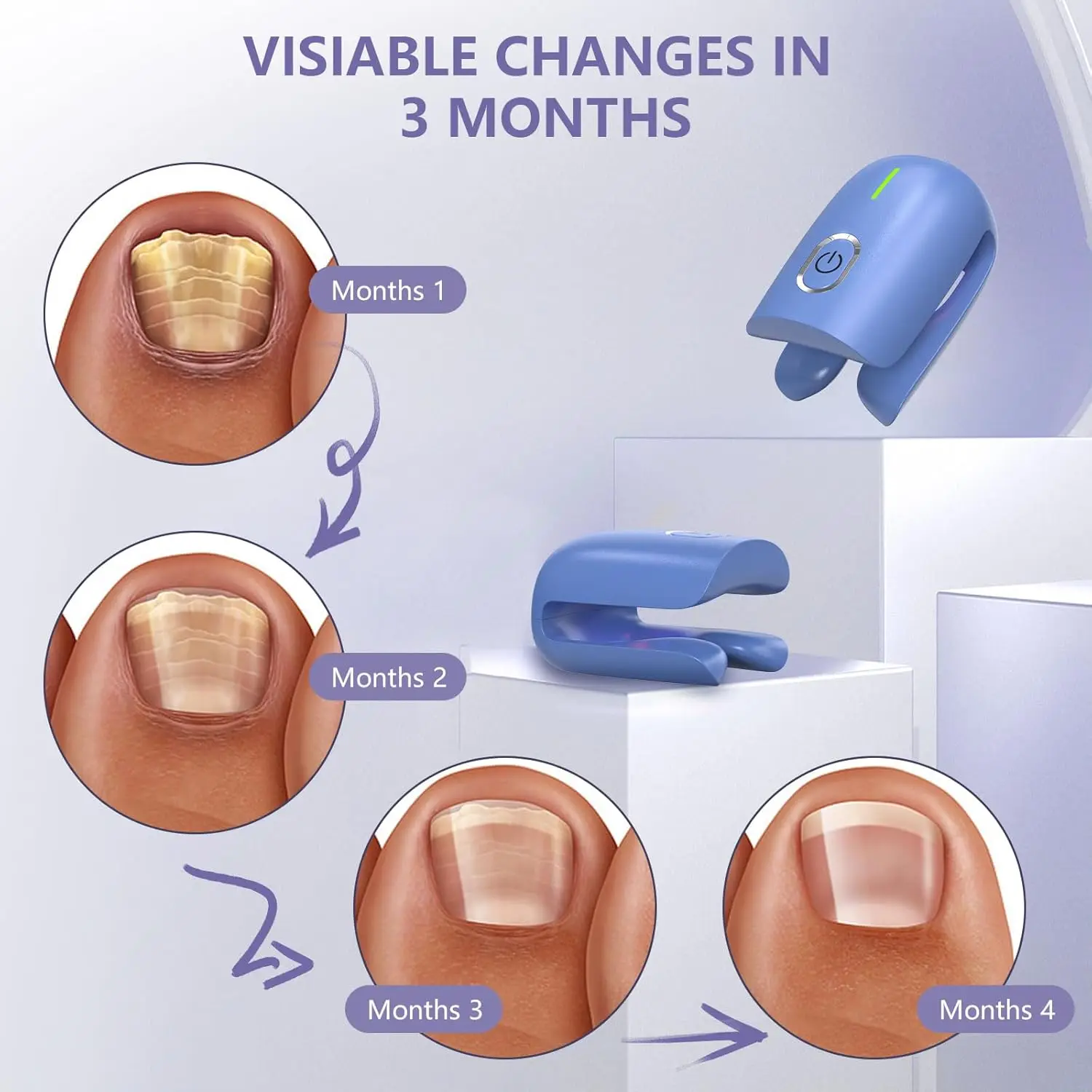 Efektiivne laserteraapia seade küüneseene raviks koos fotodega nelja kuu küünte paranemise protsessist, sinine seade valgel taustal.