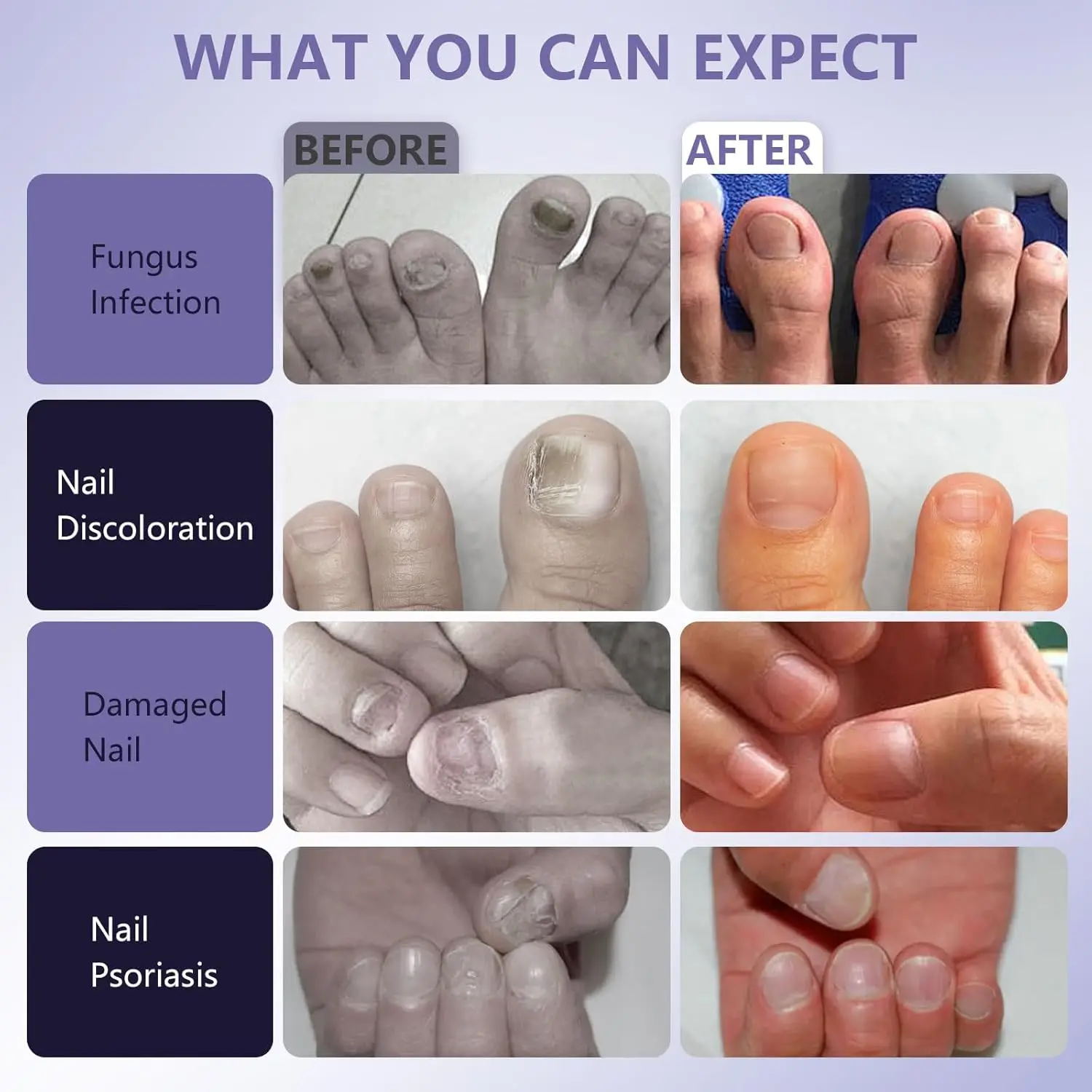 Pilt näitab enne ja pärast tulemusi jalgadel ja kätel pärast Efektiivne laserteraapia seade küüneseene raviks kasutamist. Vasakul pool on küüneseente ja värvimuutustega kahjustatud küüned ning paremal tervemad ja puhtad küüned.