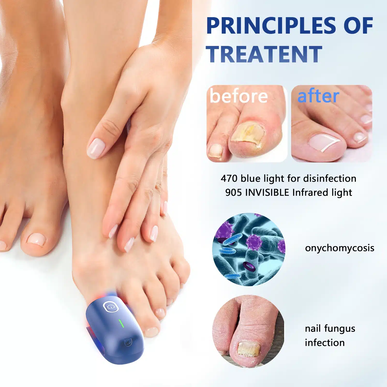 Efektiivne laserteraapia seade küüneseene raviks asetatud suure varba peale puhtal valgel taustal koos raviprotsessi illustratsiooniga enne ja pärast.